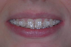 Ortodonzia fissa estetica